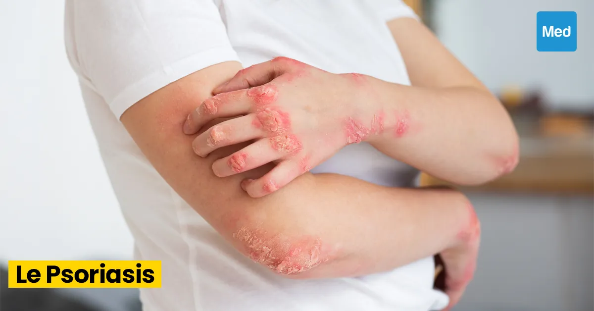 Psoriasis : comprendre la maladie et vivre au mieux